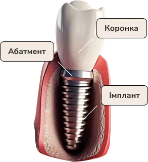 імплантація зубів Київ