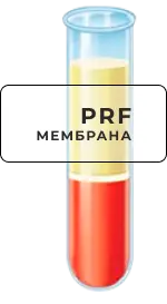 Використовуємо технологію підсадки  PRF - мембрани
