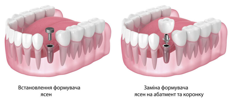 Установка формувача ясен та варіанти цього етапу