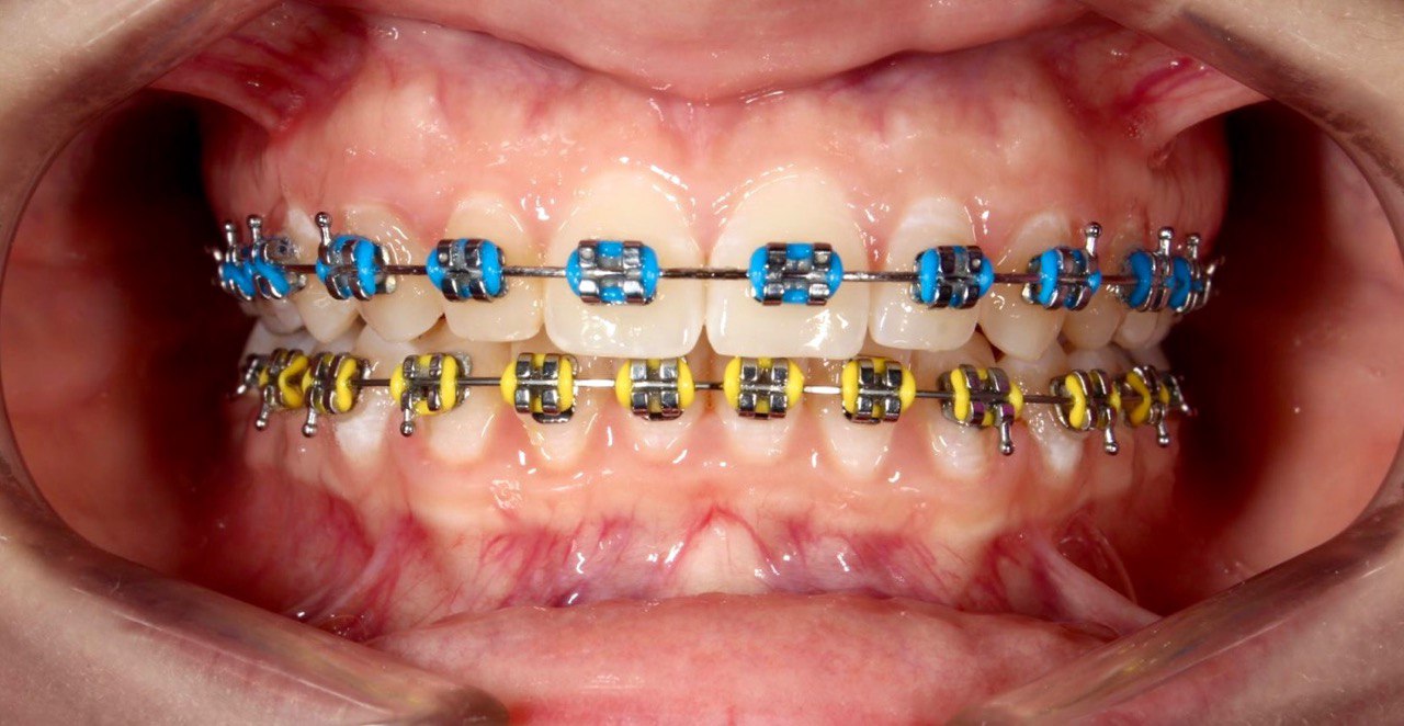 Сучасні естетичні брекет-системи: переваги, різновиди та догляд 2 Можливість фарбування матеріалу брекетів