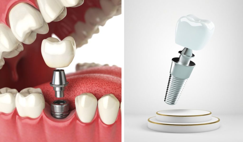 Які бувають зубні протези: огляд різновидів, матеріалів і правил догляду 3 Процес виготовлення та встановлення протезів