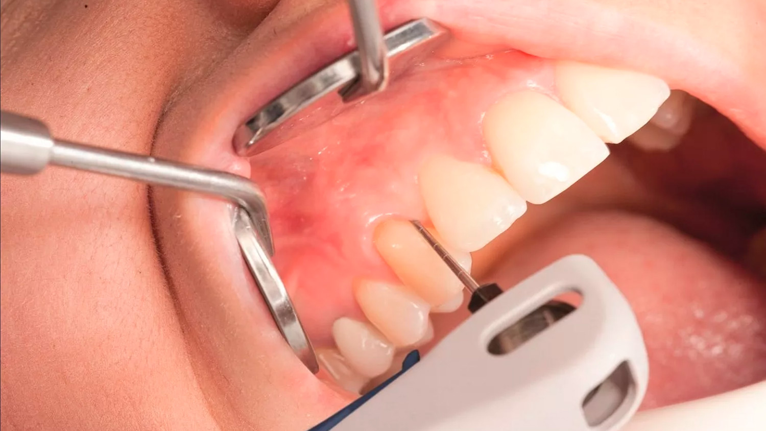 Запалення ясен: ознаки та лікування 1 Лікування запалення ясен