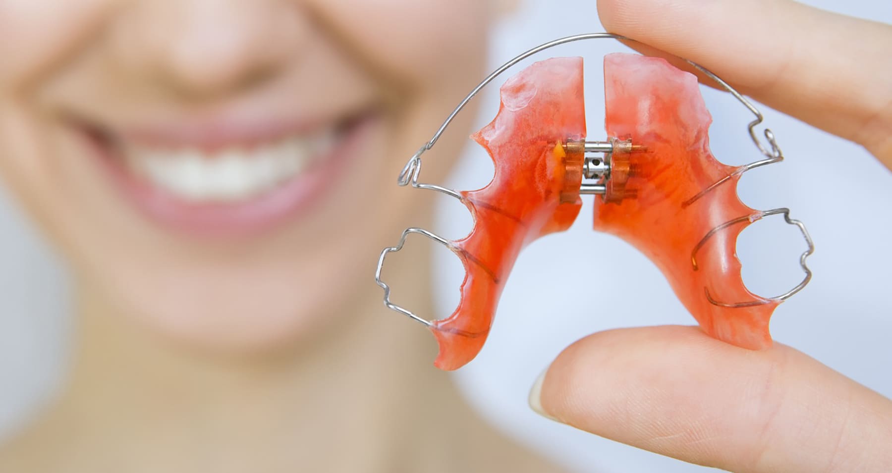 Як вирівняти зуби без брекетів: альтернативні методи та їхня ефективність 4 Що таке ортодонтичні пластини