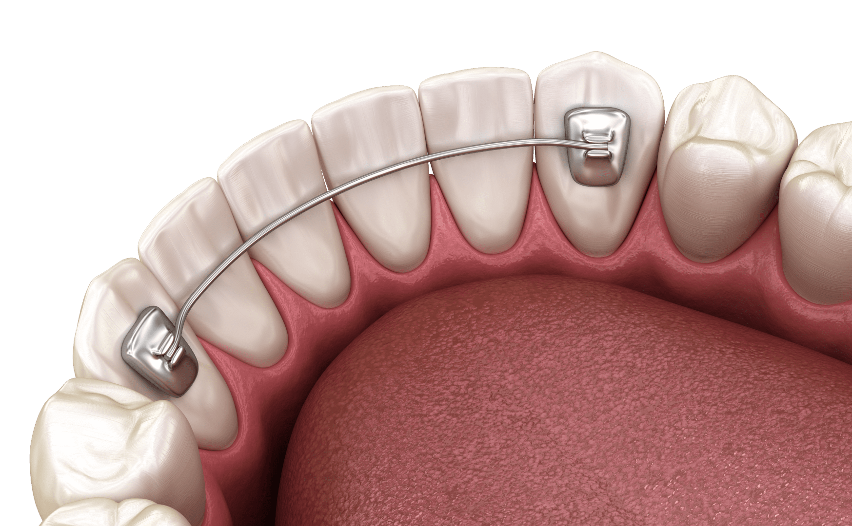 Ретейнери після брекетів: навіщо та скільки потрібно носити ретейнери для збереження вашої усмішки 1 Що таке ретейнери, та чому їх потрібно носити, коли знімають брекети