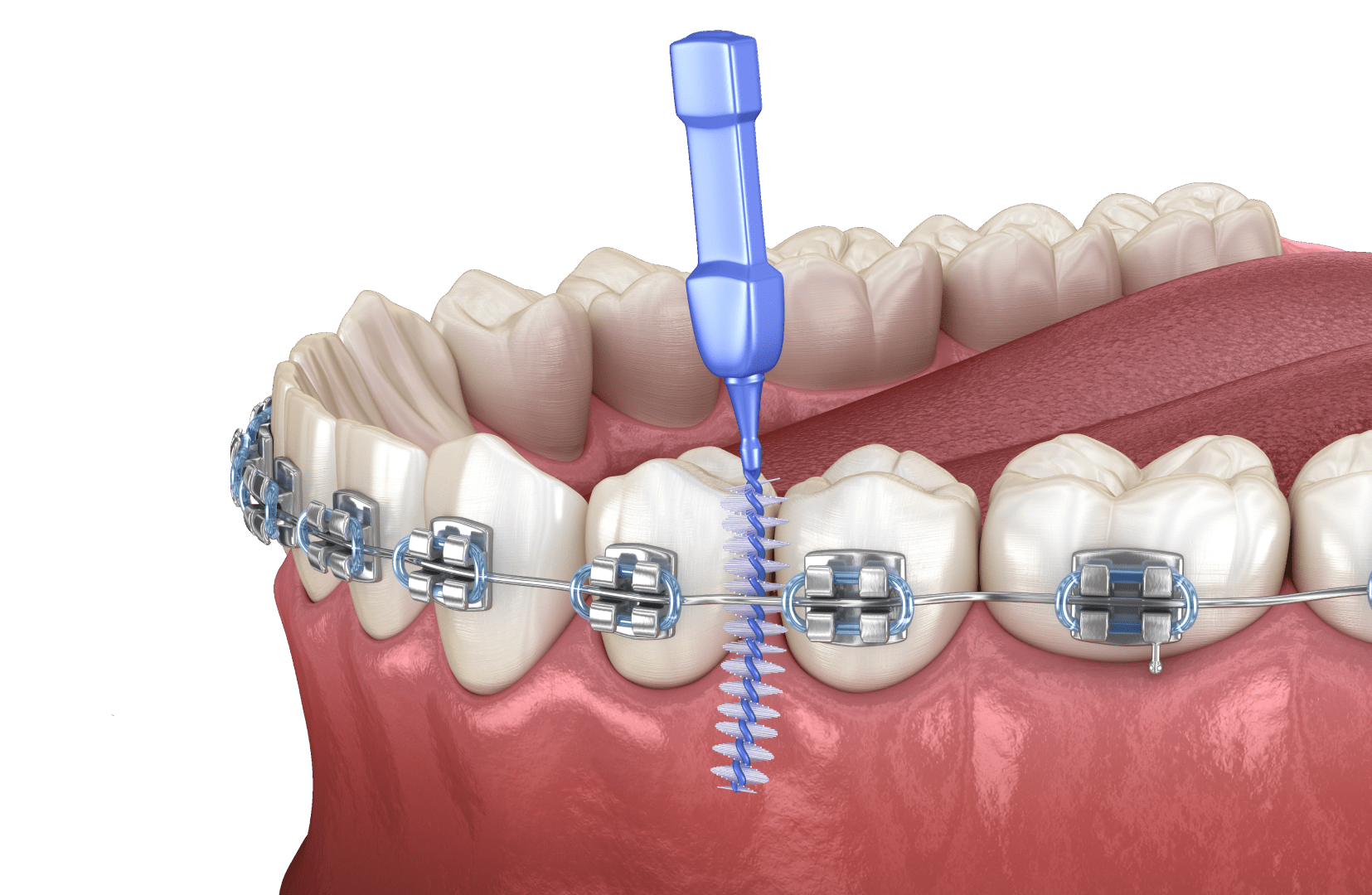 Сапфірові брекети: ціна на встановлення сапфірової брекет-системи 4 Догляд за сапфіровими брекетами
