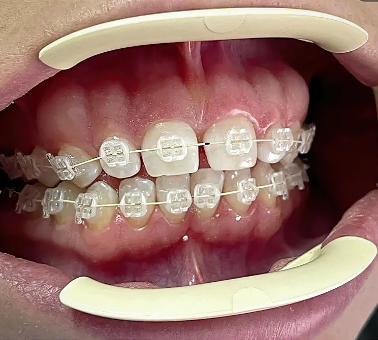 Сапфірові брекети: ціна на встановлення сапфірової брекет-системи 2 Переваги сапфірових брекетів