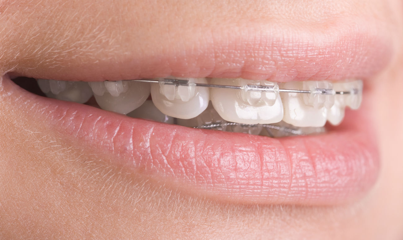 Сапфірові брекети: ціна на встановлення сапфірової брекет-системи 3 Процес встановлення та адаптації