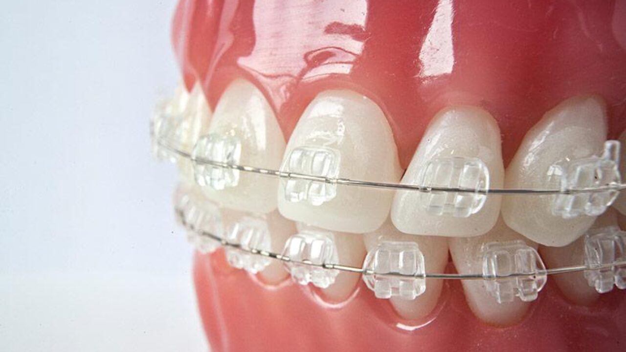 Сапфірові брекети: ціна на встановлення сапфірової брекет-системи 1 Чому сапфірові брекети відрізняються від інших типів