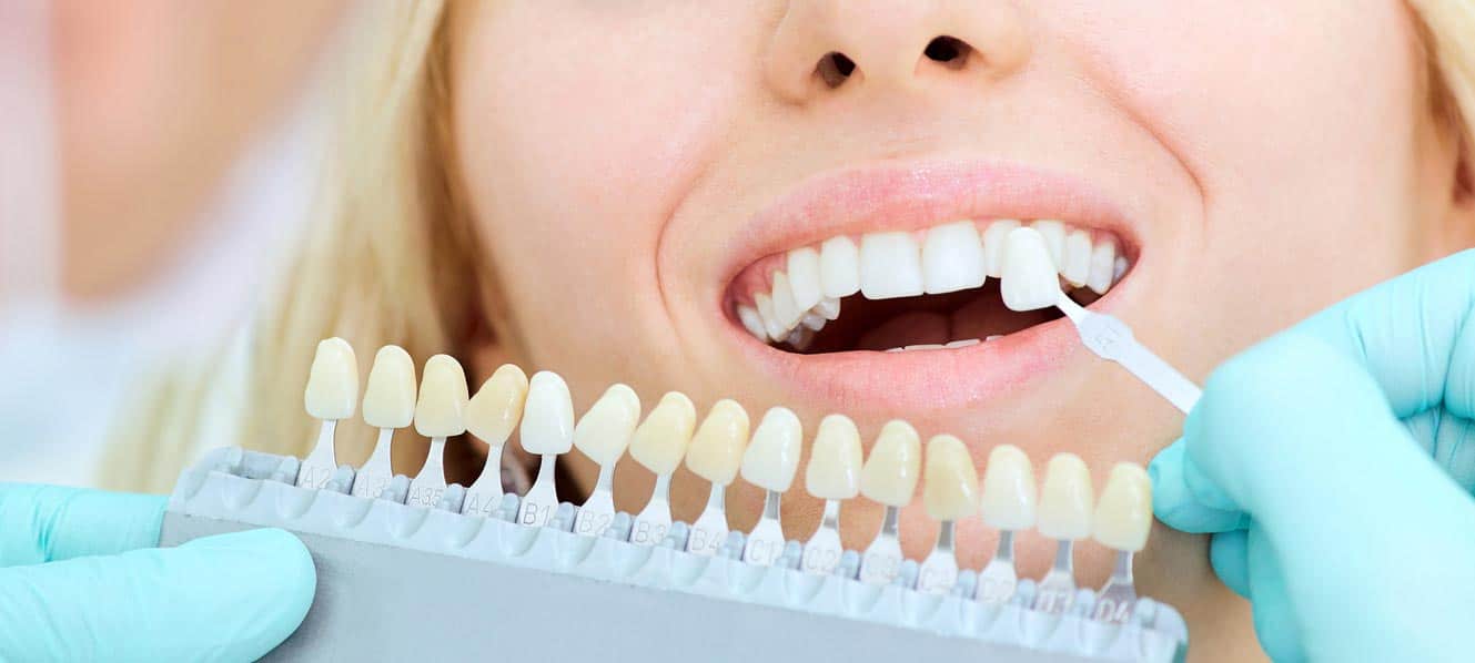 Клініка UkrDentClub – надійна допомога в галузі ортопедичної стоматології 2 Протезування в галузі ортопедичної стоматології, коли збереження природного зуба неможливе