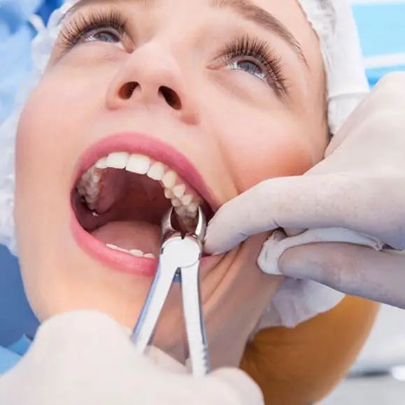 Видалення премолярів: важливість та особливості процедури 1 Показання до операції з видалення премолярів