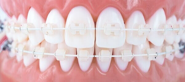 Керамічні брекети: ефективне вирівнювання зубів 1 Показання до встановлення керамічних брекетів