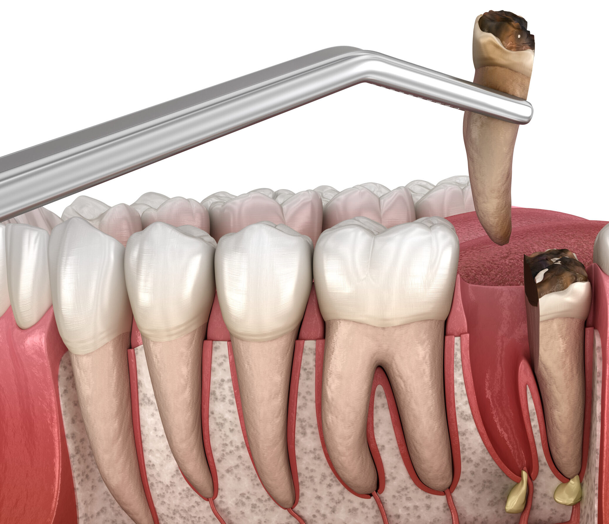 У яких випадках атипове видалення зубів відкладають