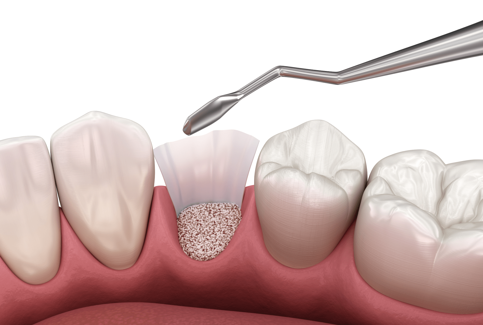 Нарощування кісткової тканини для імплантації: основні різновиди