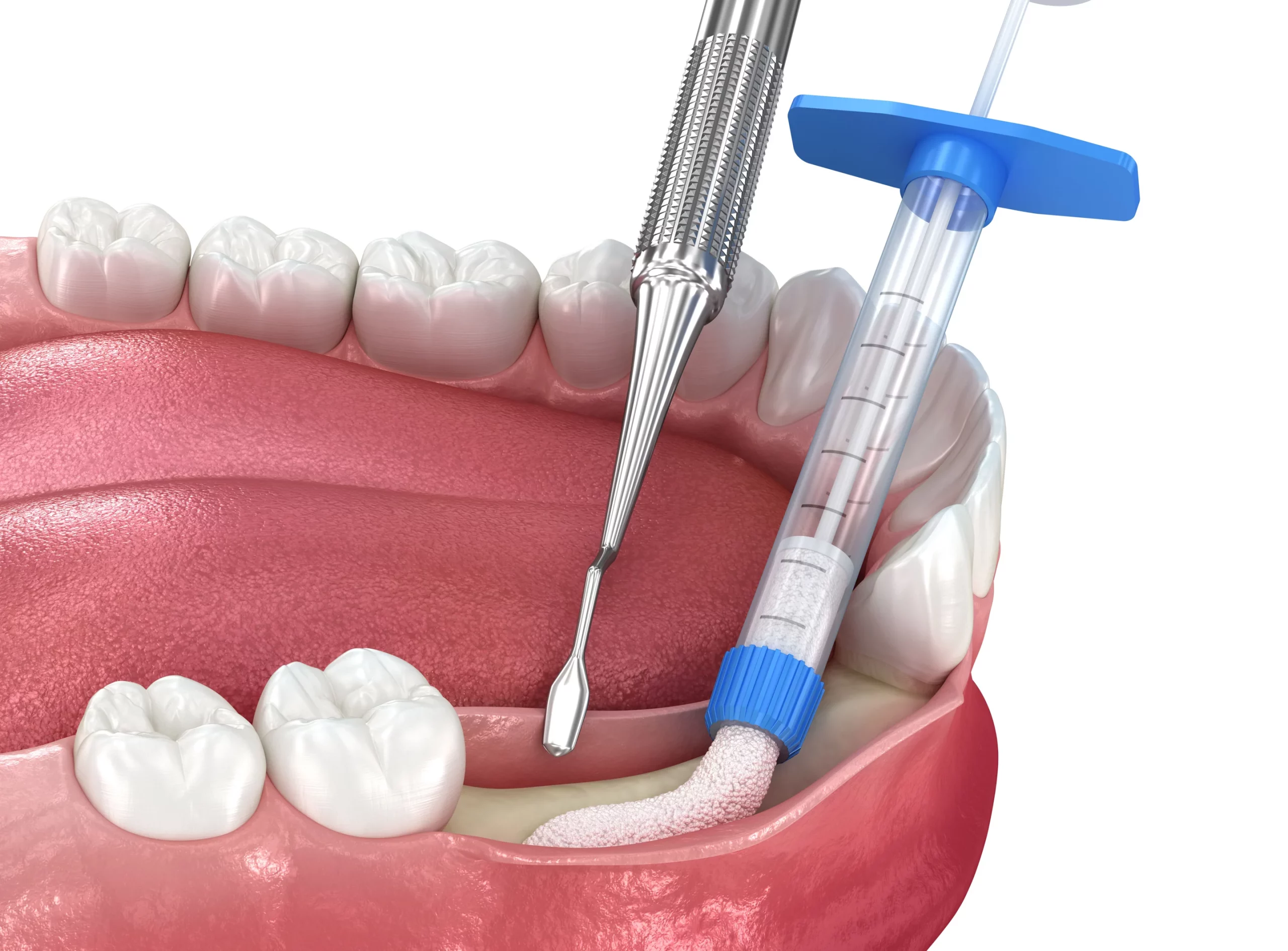 Матеріали, що застосовуються для лікування атрофії кісткової тканини