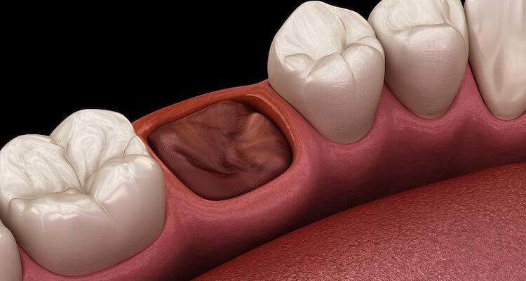 Видалення молярів: важливість та особливості процедури 1 Що необхідно знати перед видаленням молярів