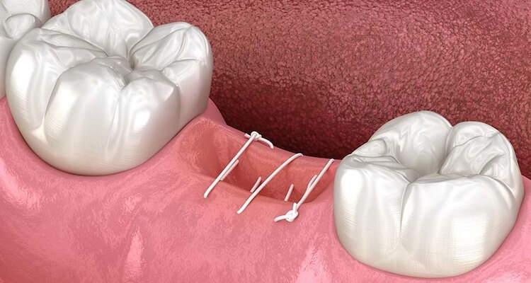 Видалення молярів: важливість та особливості процедури 2 Можливі ускладнення після операції з видалення молярів