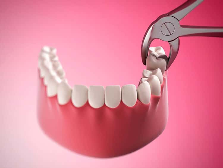 Видалення премолярів: важливість та особливості процедури 2 Процедура видалення премолярів із використанням анестезії в стоматології UkrDentClub