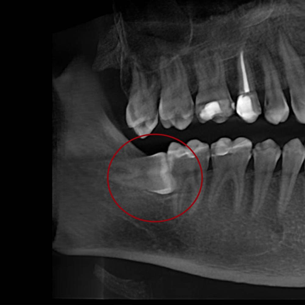 Різновиди складного видалення: видалення зуба мудрості чи кореня зуба, екстракція зуба з новоутворенням