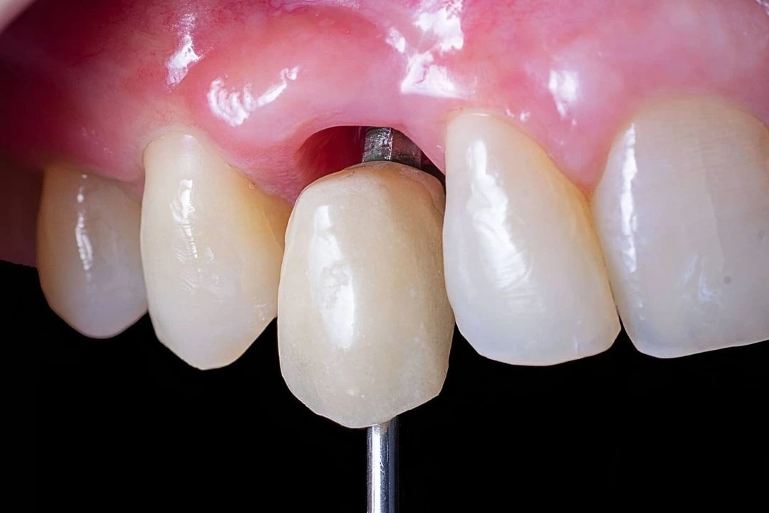 Операції з видалення різців та іклів: важливість та особливості процедур 2 Швидке та безболісне відновлення різців та іклів після процедур видалення