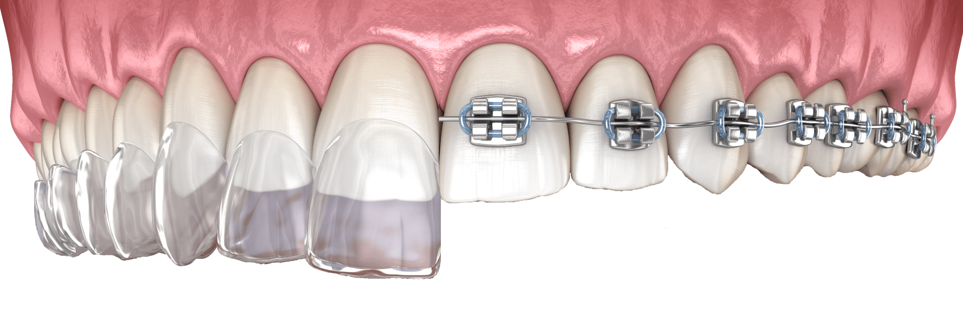 Процес ортодонтичного лікування з використанням механічних апаратів