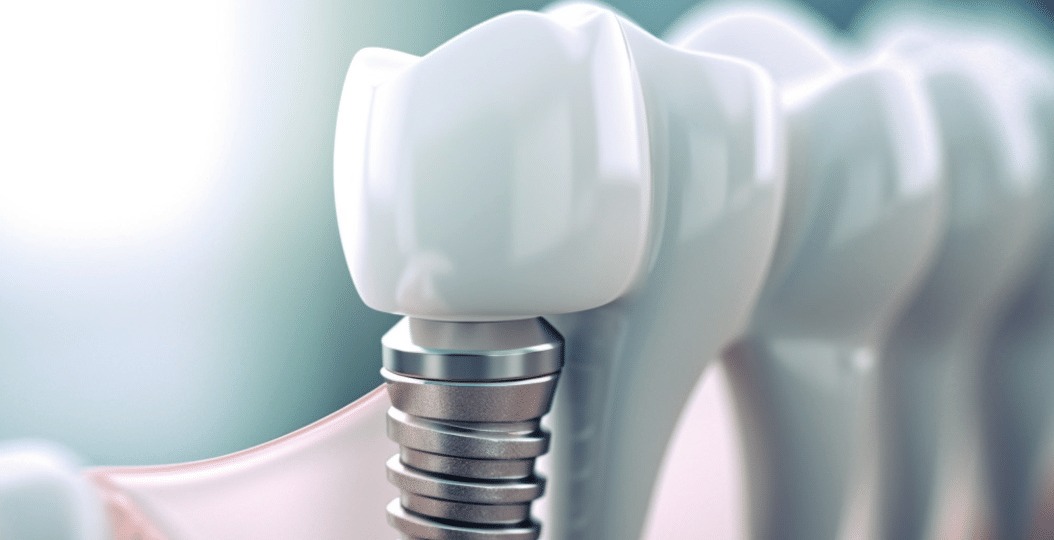 Процедура імплантації зубів у літніх людей: чи є вікові обмеження 1 Процедура імплантації в літніх людей