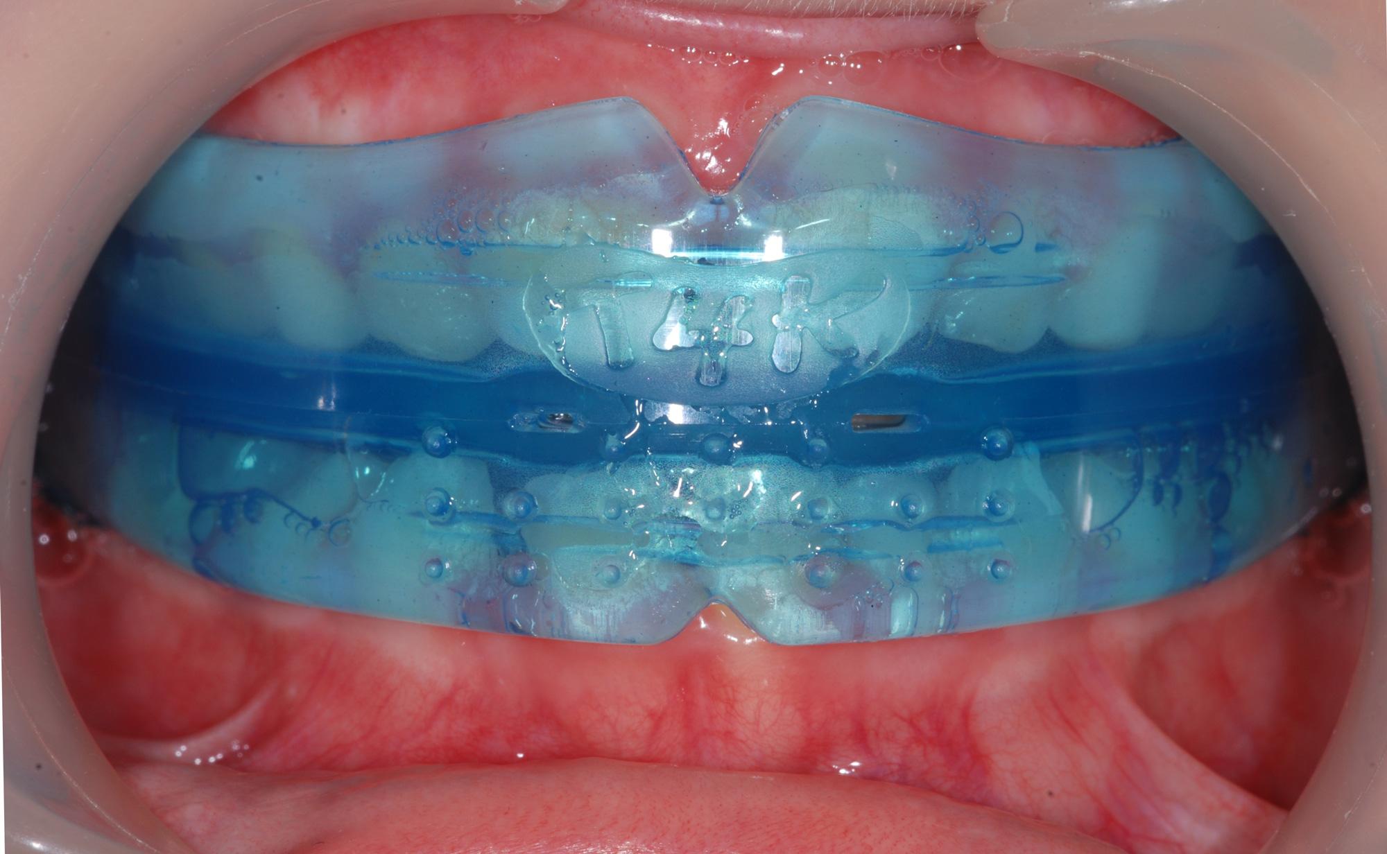 Функціонально-направляючі ортодонтичні апарати 1 Різновиди направляючих апаратів