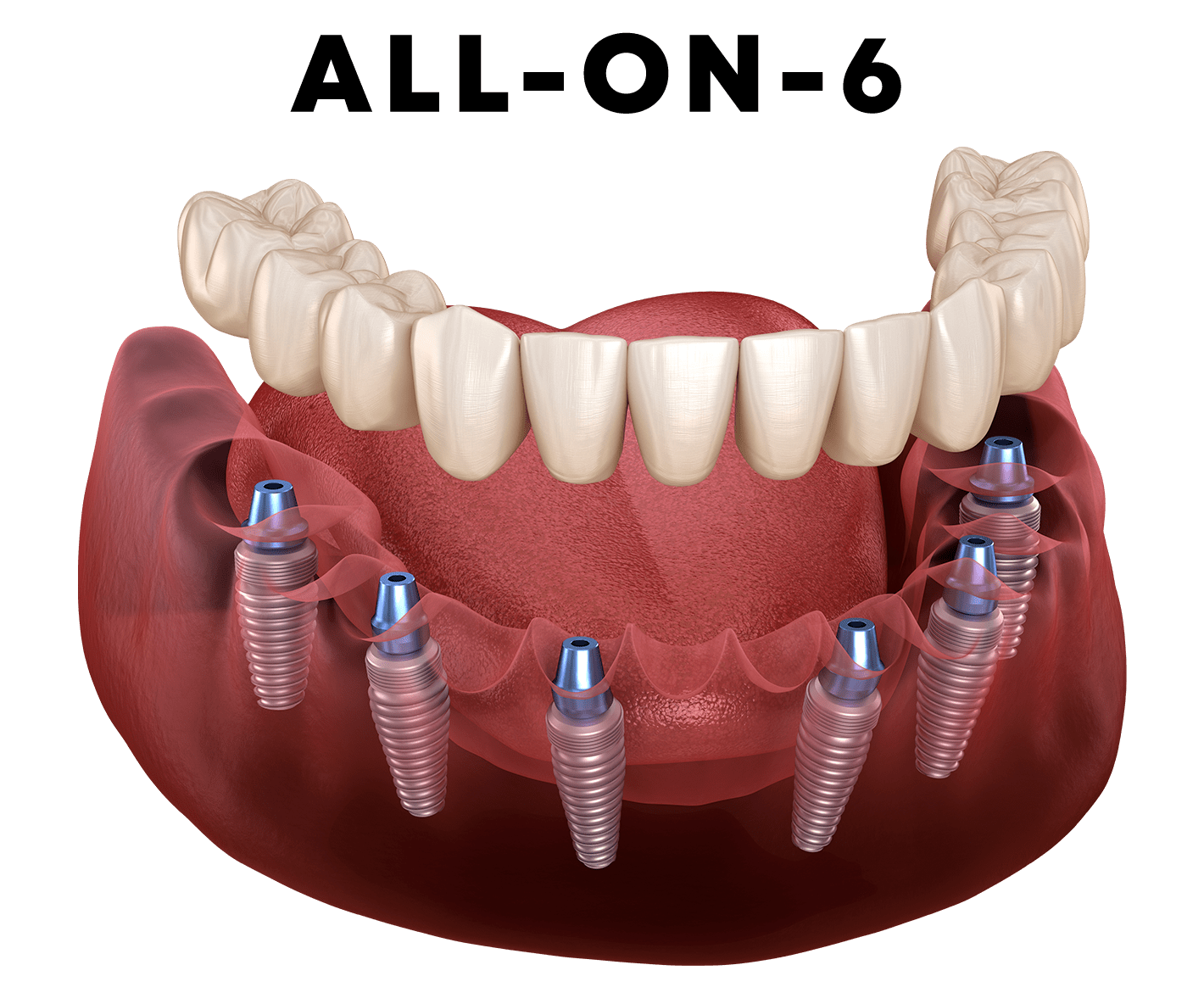 All-on-6 – протокол імплантації, що повертає гарну посмішку