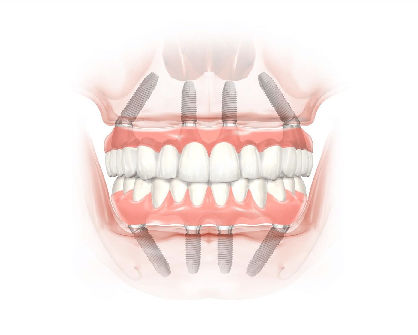 Імплантація All-on-4 та All-on-6