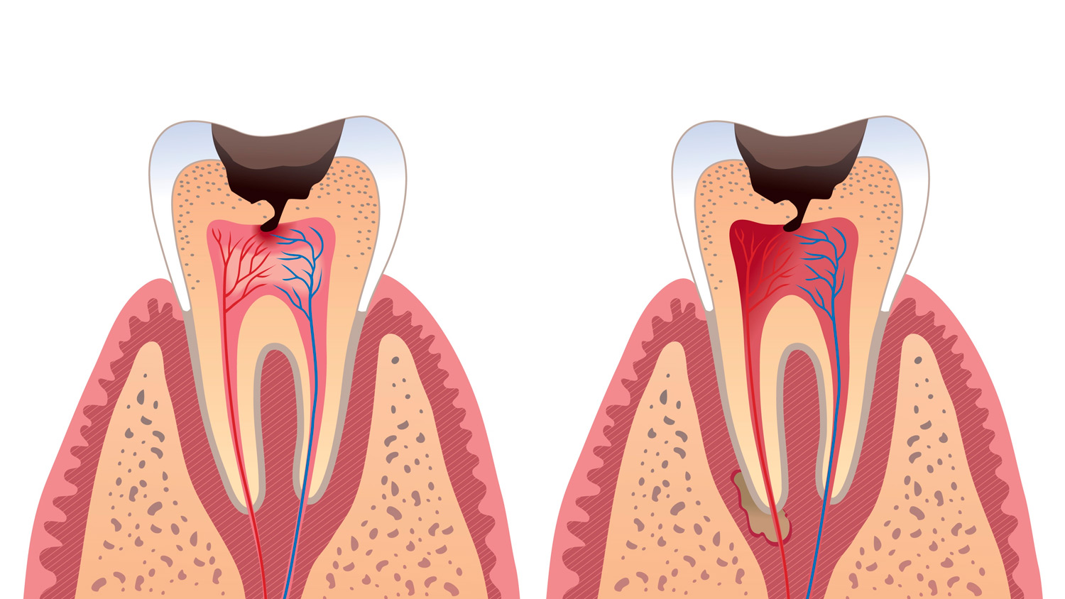 Лікування каналу зуба та можливі ускладнення після нього 3 Як уникнути ускладнень