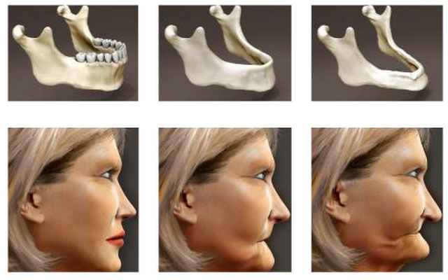 Наслідки для здоров’я щелепної кістки