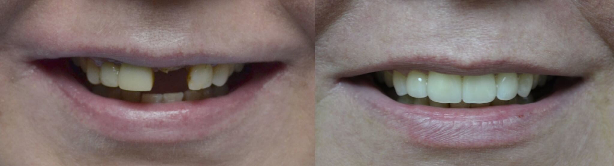 Можливі варіанти відновлення зубів