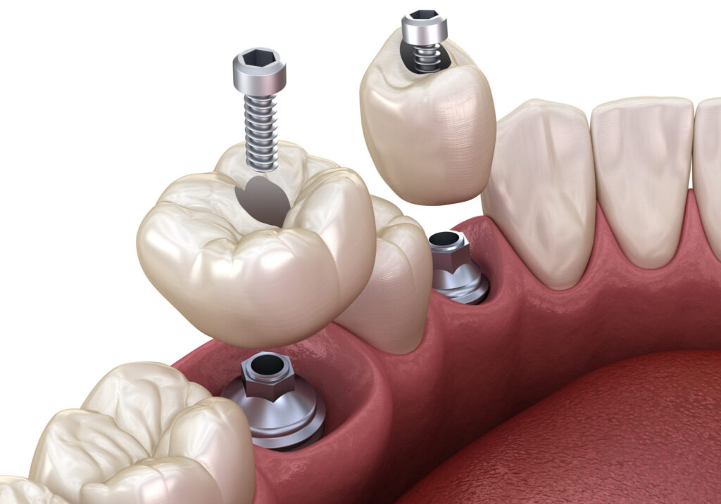 Як підготовка ясен сприяє стабільності та естетиці протеза