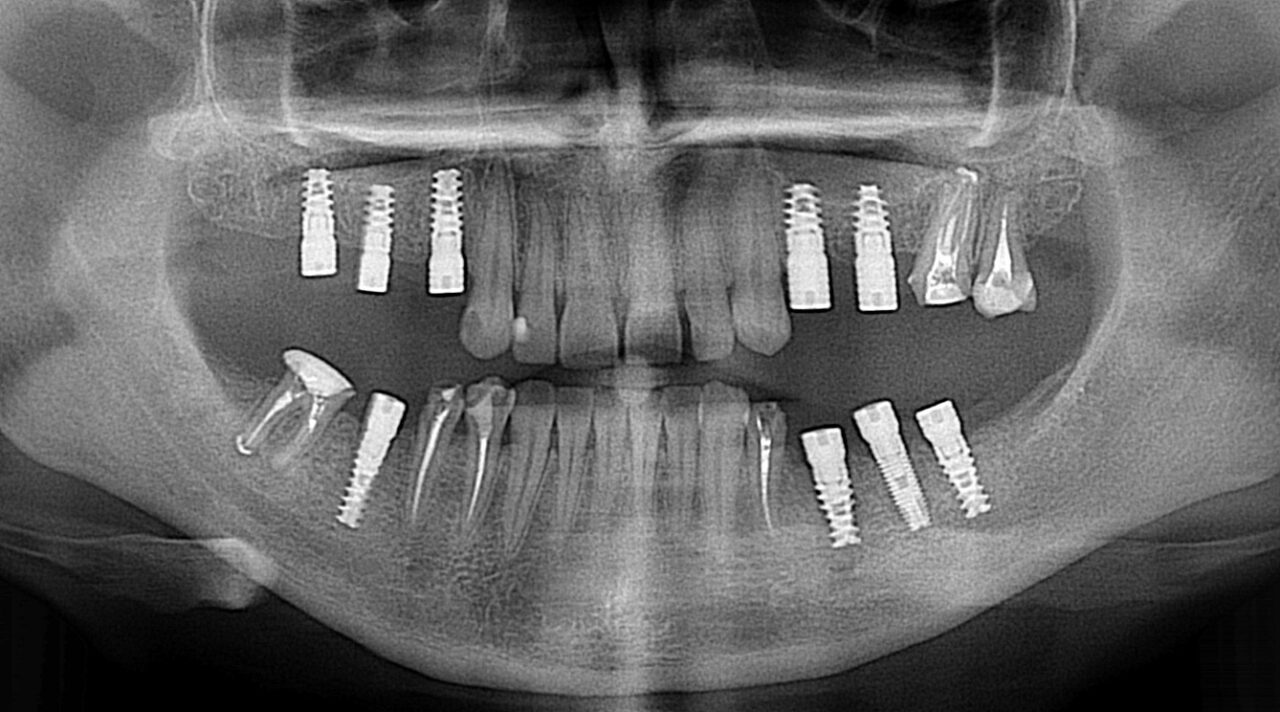 Відстрочена імплантація 3 Переваги та недоліки відстроченої імплантації