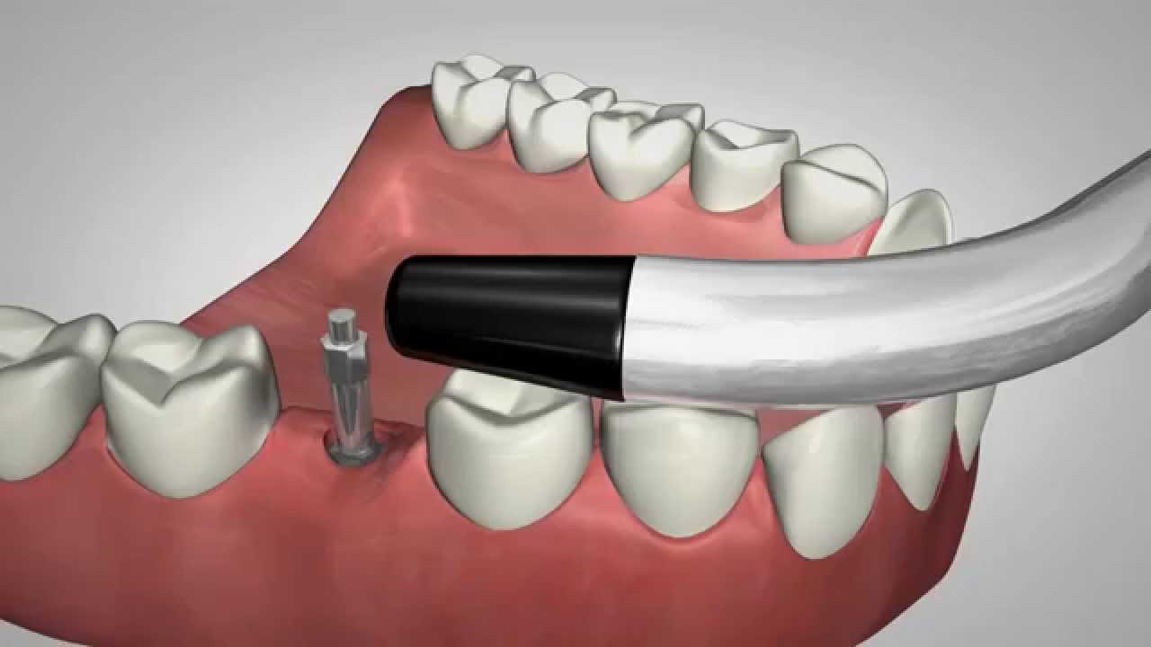 Відстрочена імплантація 2 Детально про етапи відстроченої імплантації