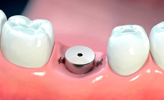 Що таке формувач ясен і його роль у підготовці до протезування