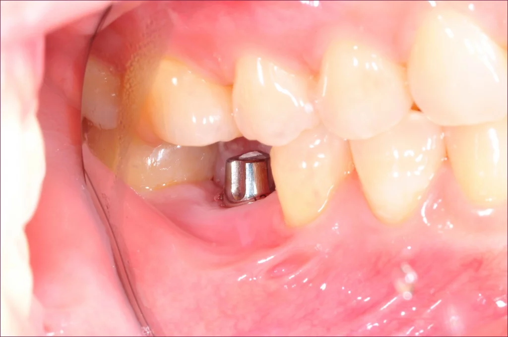 Загоєння після імплантації