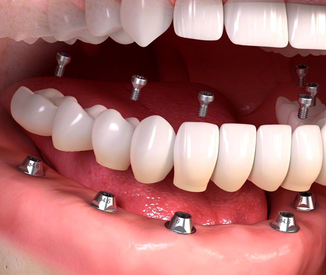 Відстрочена імплантація 4 Догляд за ротовою порожниною після відстроченої імплантації