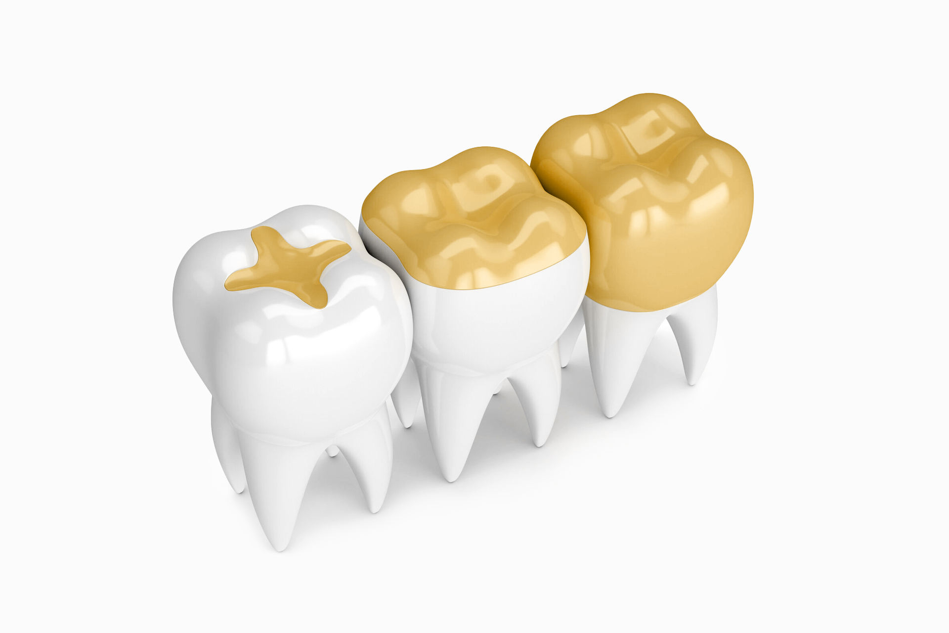 Заміна пломб на керамічні реставрації 2 Переваги керамічної реставрації, якщо порівнювати з пломбою