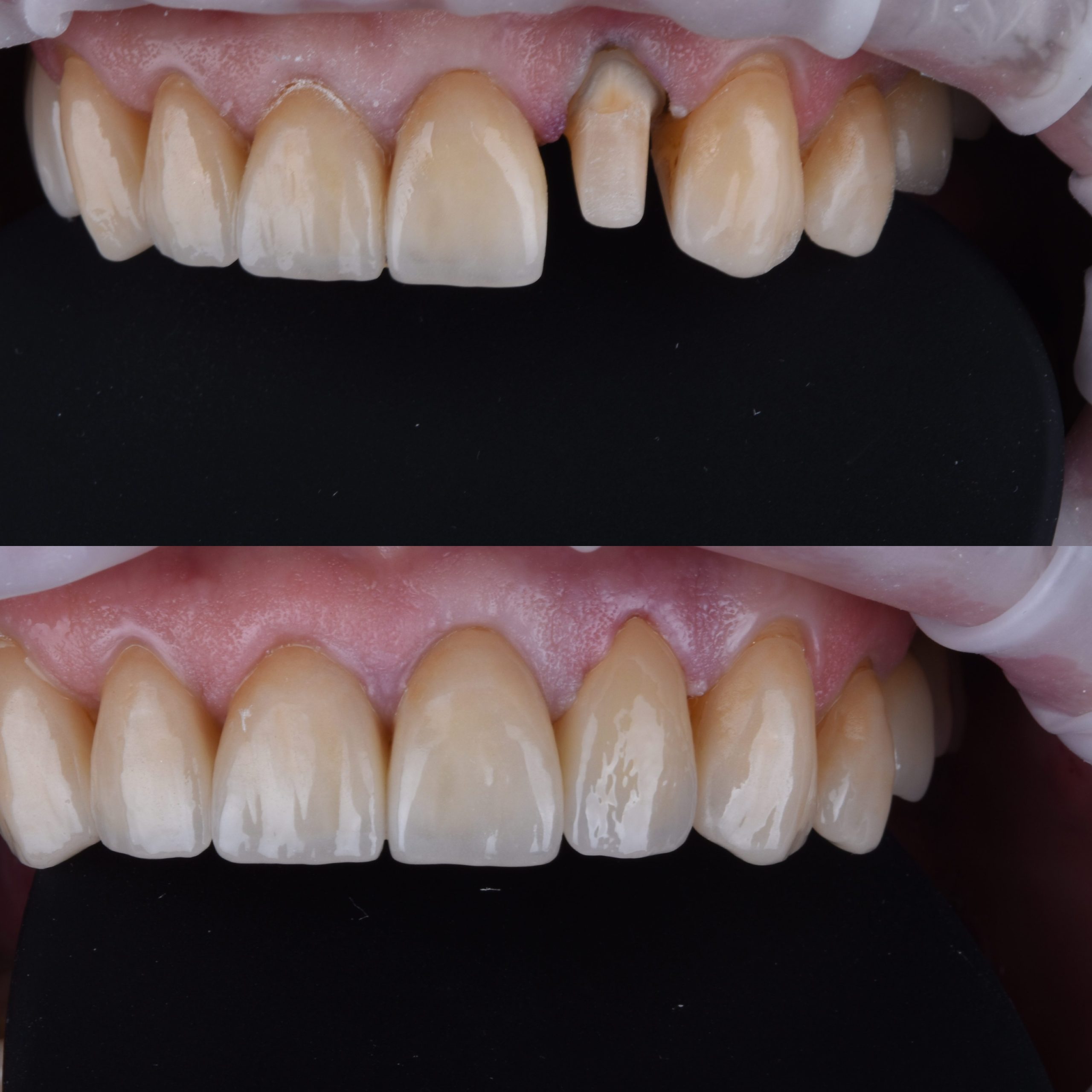 Заміна пломб на керамічні реставрації 1 Переваги керамічної реставрації, якщо порівнювати з пломбою