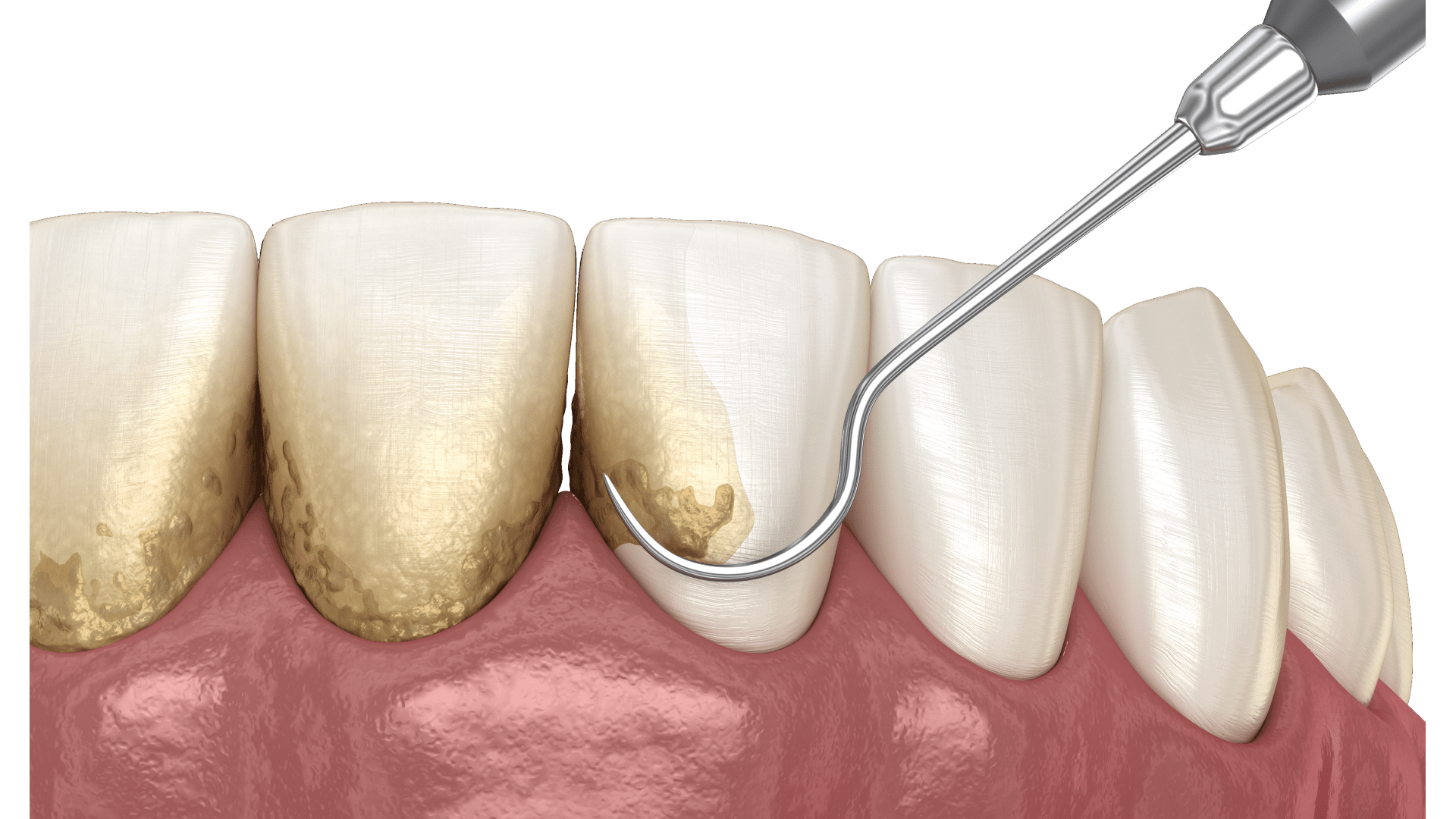 Як позбутися зубного каменю: причини, ознаки та методи чищення 1 Причини появи зубного каменю