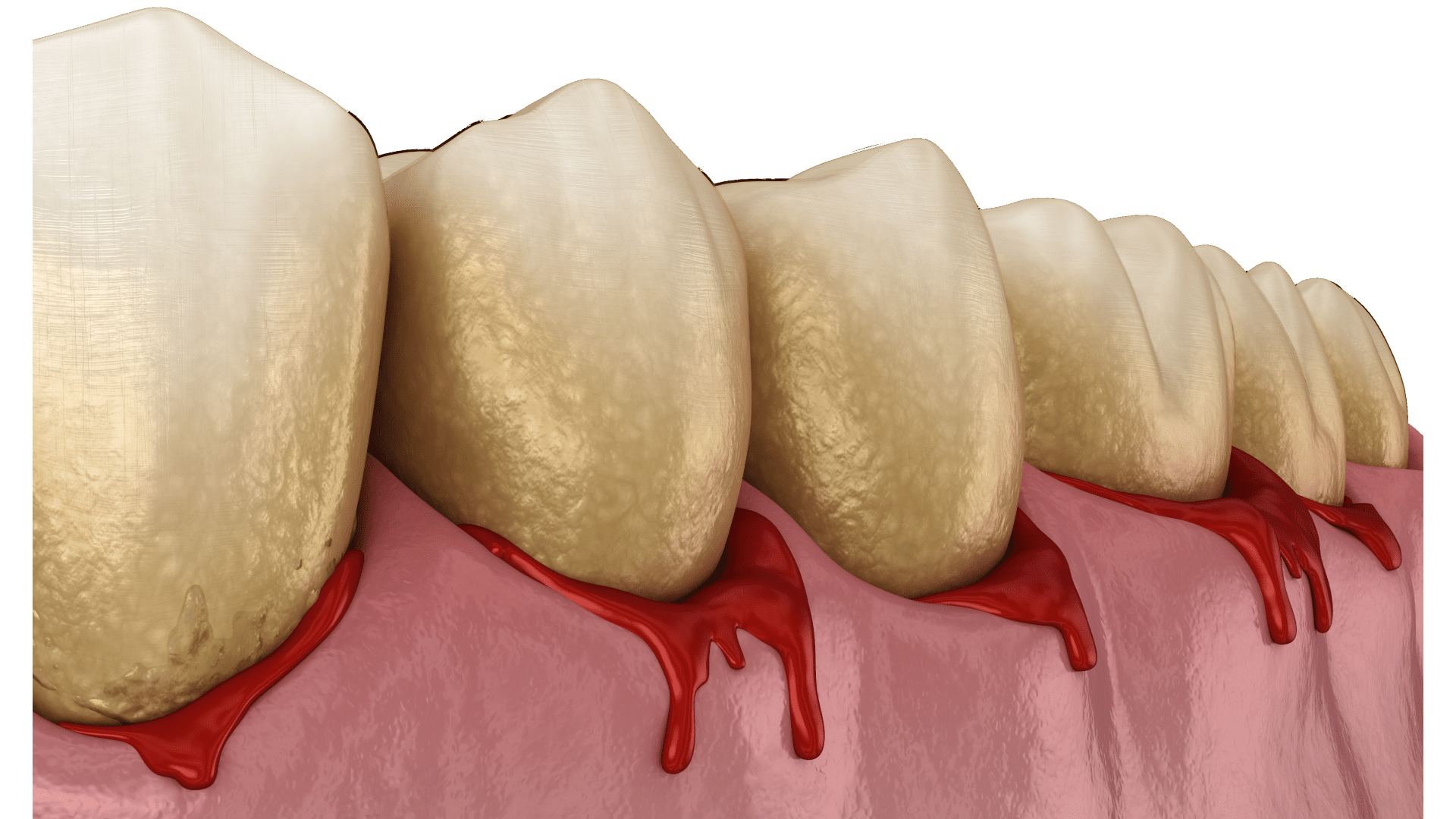 Як позбутися зубного каменю: причини, ознаки та методи чищення 2 Як відбувається поява каменю на зубах