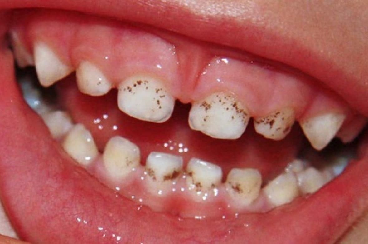 Чорні плями на зубах 4 Профілактика чорних плям для різних вікових груп