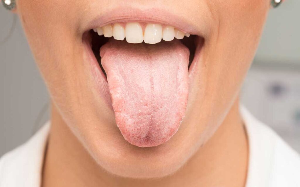 Відчуття печіння в роті 1 Що таке синдром печіння в роті