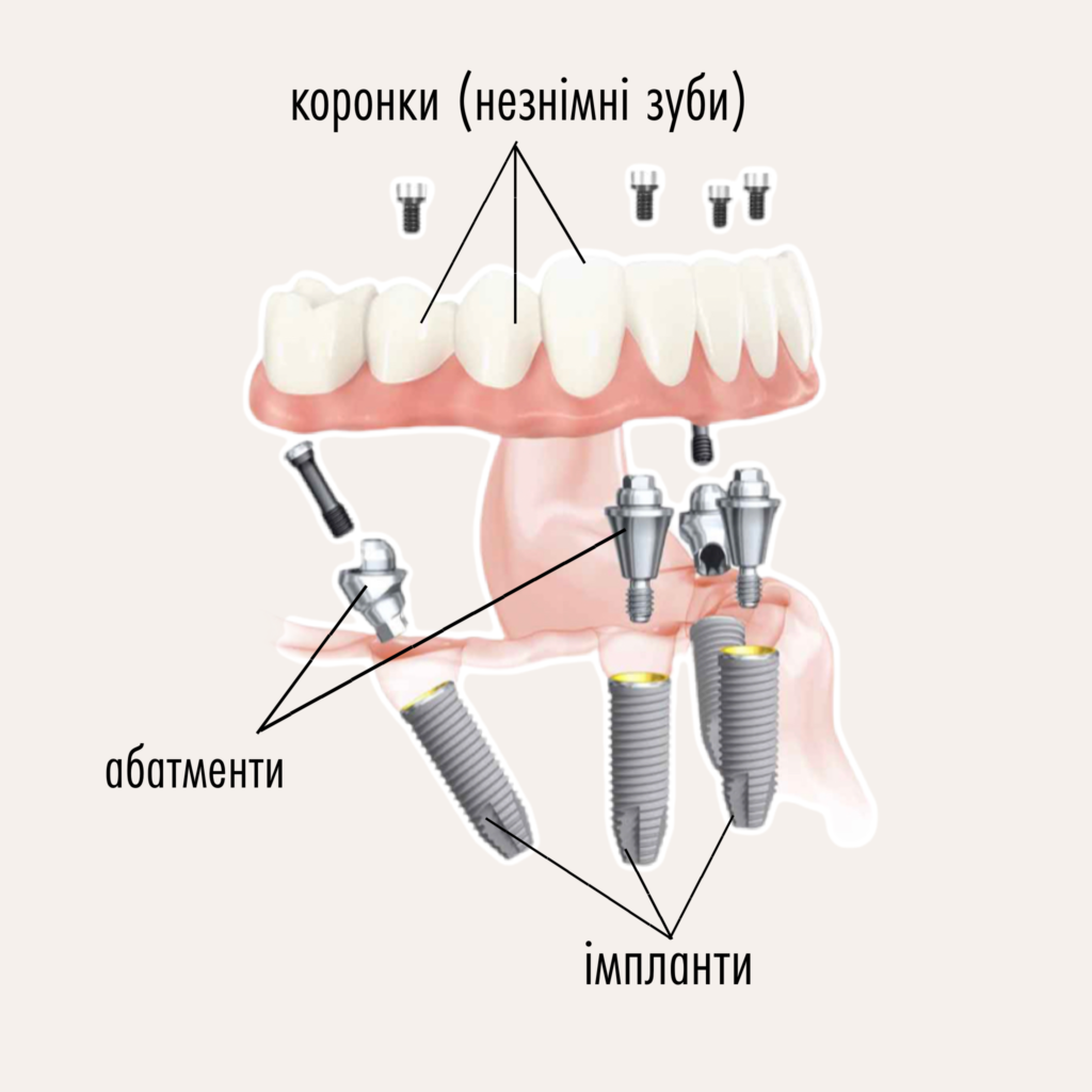 Що таке імпланти зубів та які бувають типи імплантації