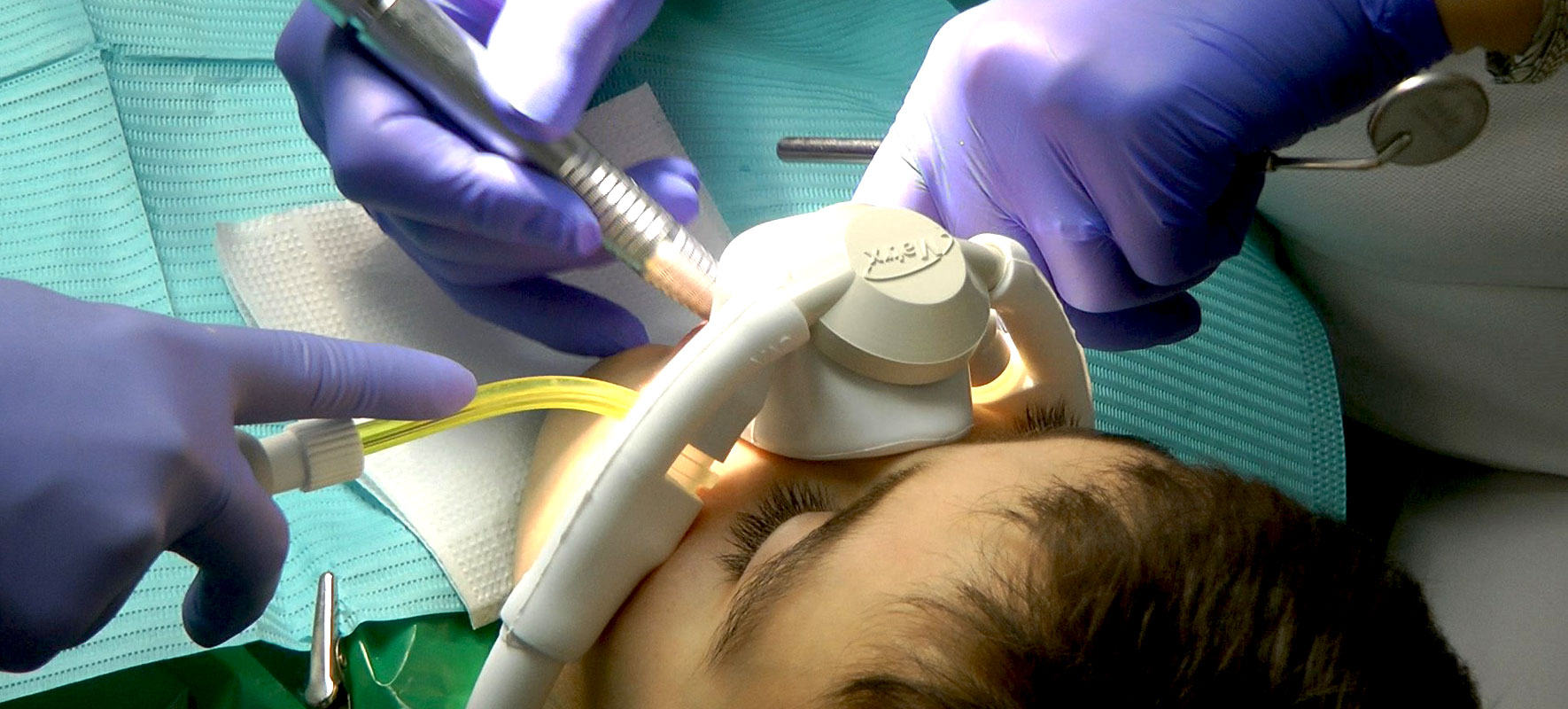 Що таке седація в стоматології