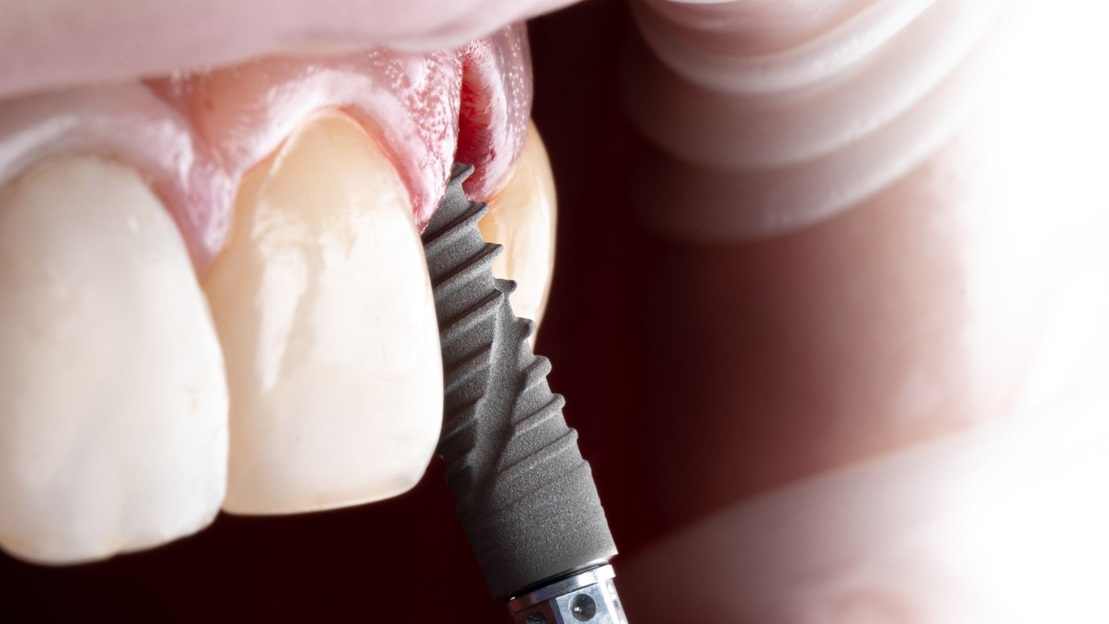 Переваги експрес-протезування після імплантації зубів