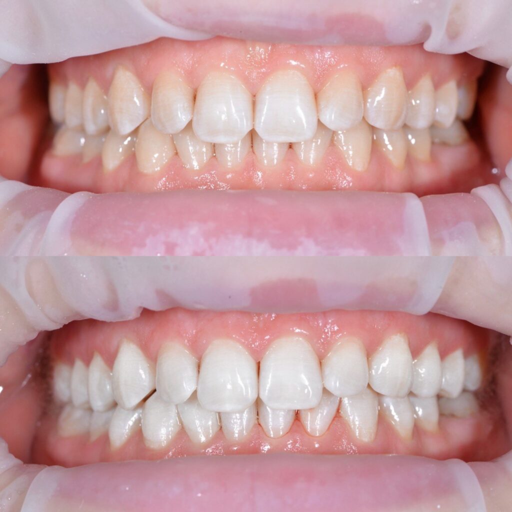 Відбілювання зубів: ціна процедури 2 Де можна відбілити зуби: ціна в Києві