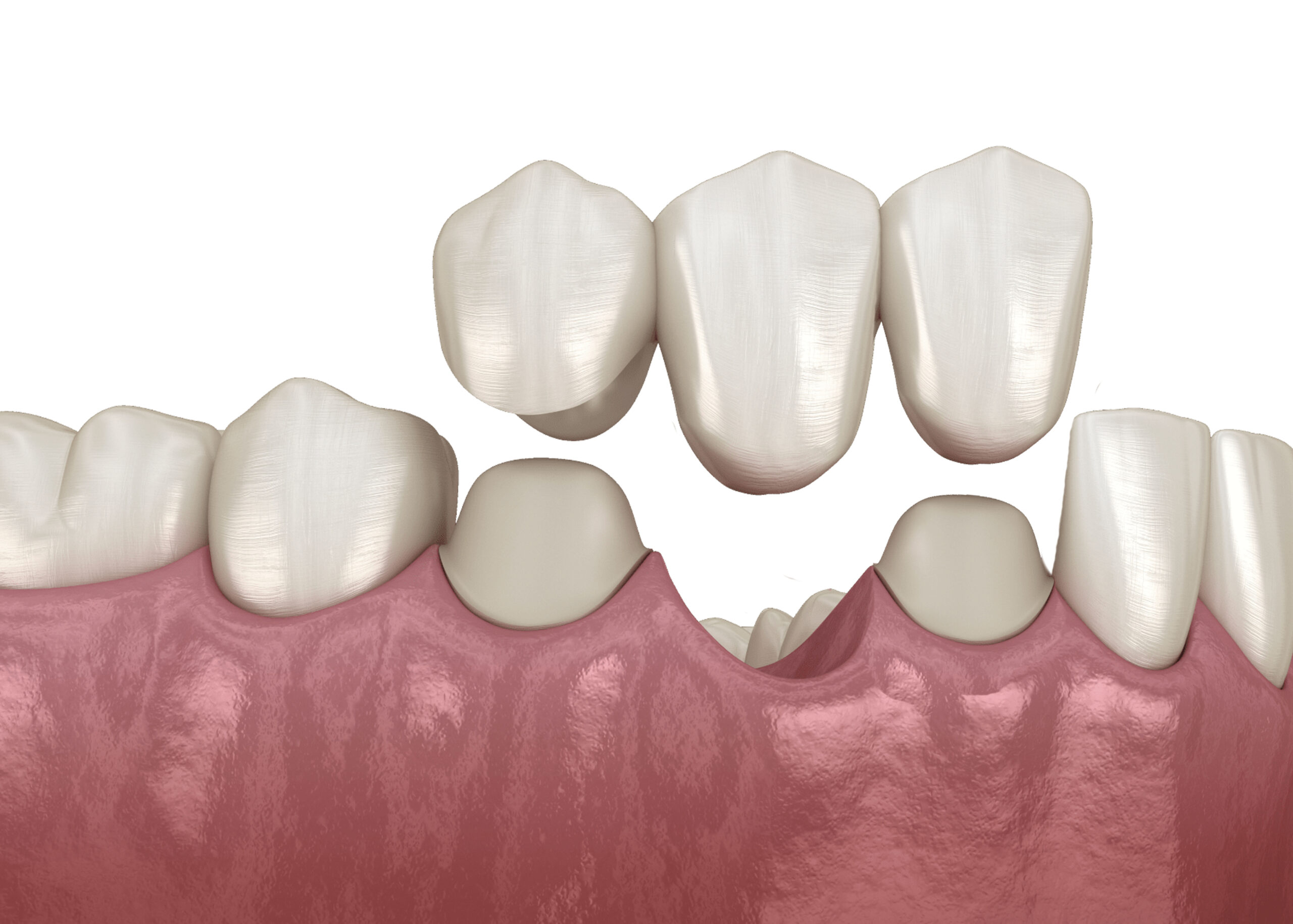 Процес видалення зуба з одночасним встановленням імпланту