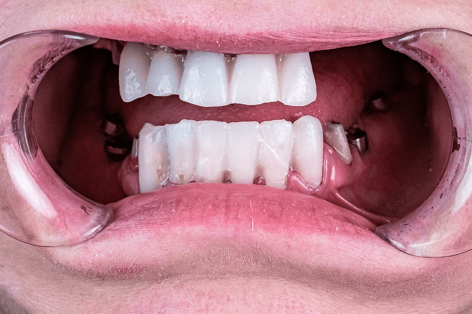 Особливості протезування після видалення зуба