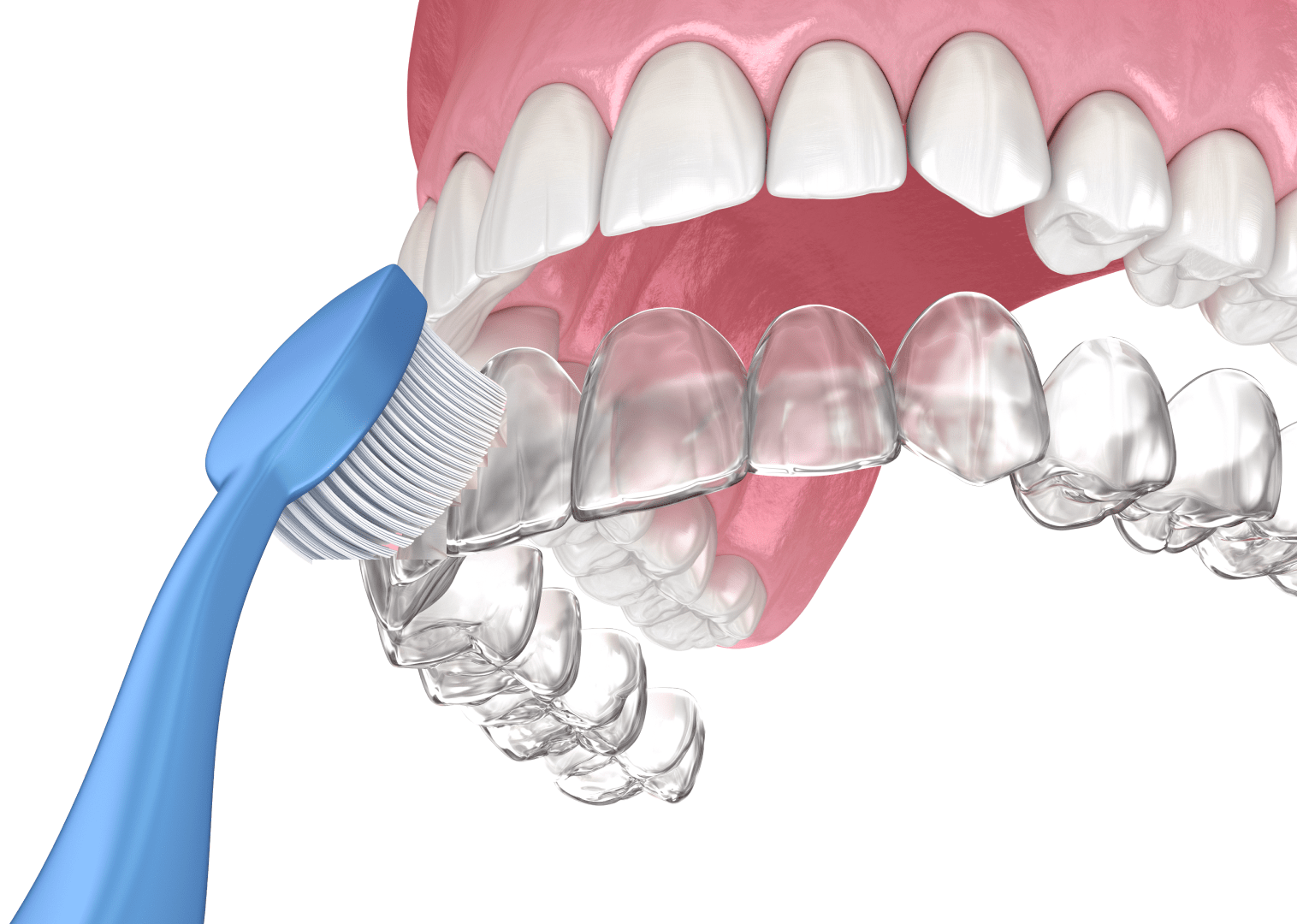 Кому не можна носити елайнери?